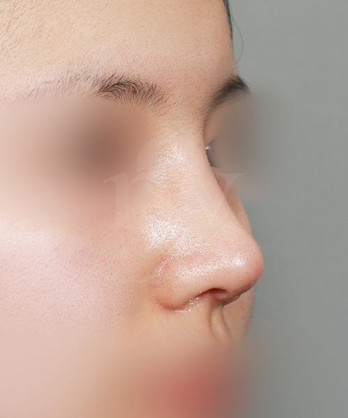 낮은코교정 수술 한달 후 45도