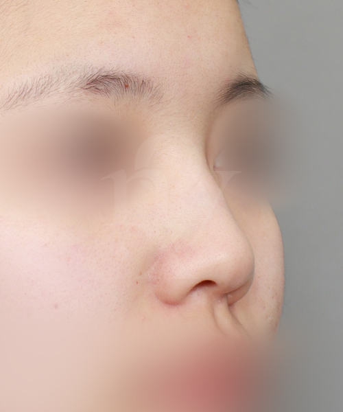 낮은코교정 수술 전 45도