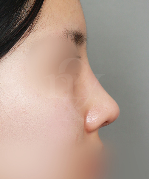 낮은코교정 수술 한달 후 측면