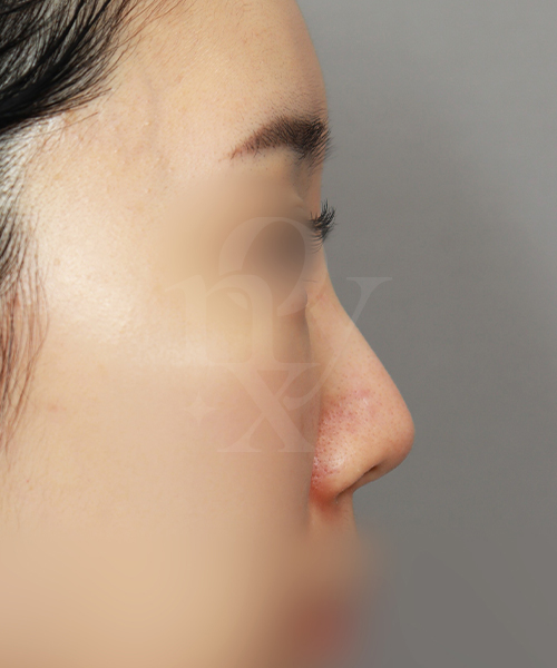 코재수술 [짧은코교정] 수술 전 측면