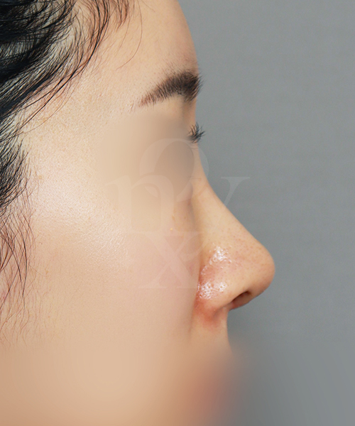 코재수술 [짧은코교정] 수술 한달 후 측면