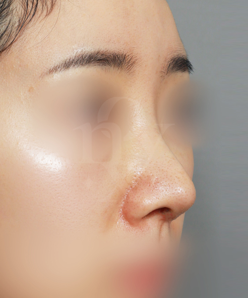 코재수술 [짧은코교정] 수술 한달 후 45도