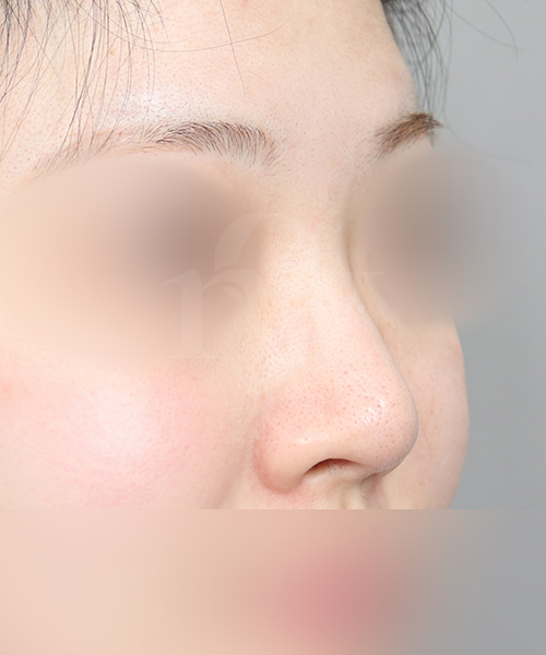 복코재수술 수술 전 45도