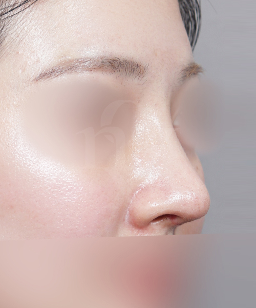 복코재수술 수술 한달 후 45도
