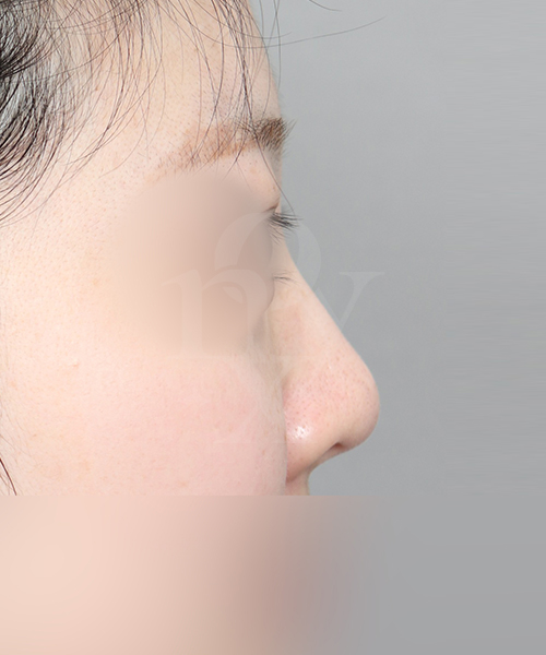 복코재수술 수술 전 측면