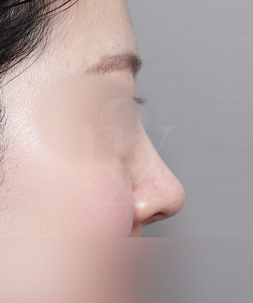 복코재수술 수술 한달 후 측면