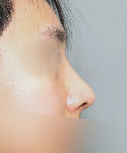 매부리코 교정 수술 한달 후 측면