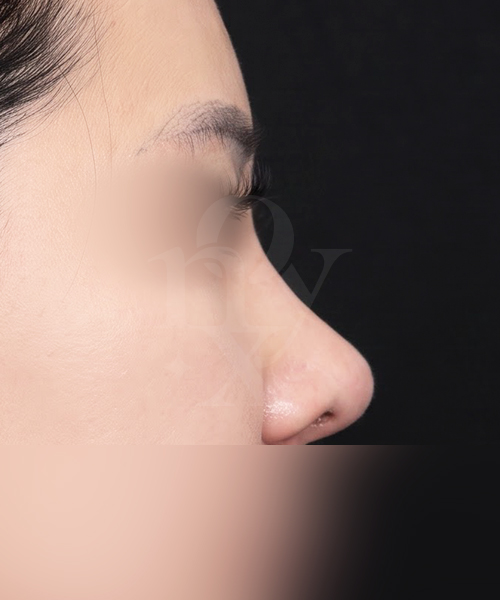 복코 수술 한달 후 측면