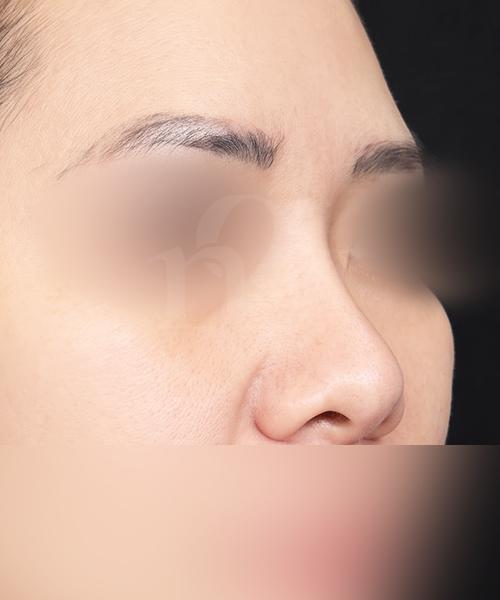 복코 수술 전 45도