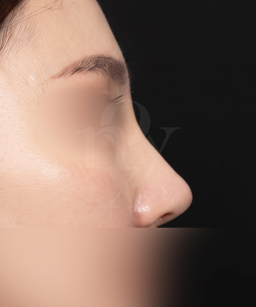 매부리코+복코+낮은코 수술 한달 후 측면