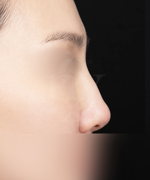 매부리코+복코+낮은코 수술 전 측면