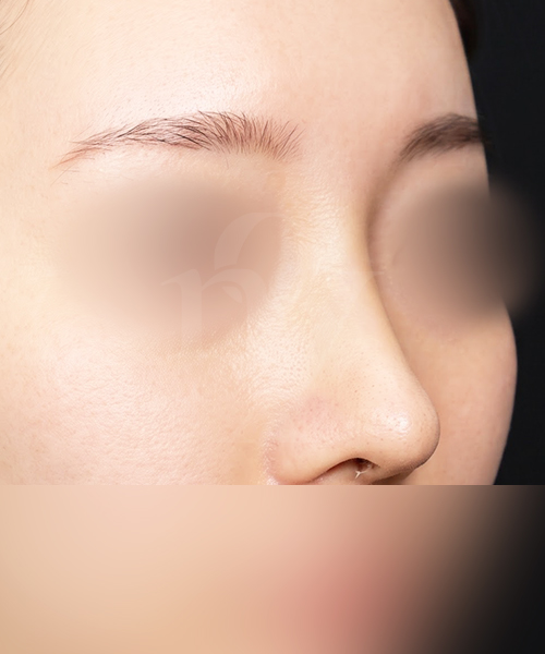 복코+매부리코 수술 한달 후 45도