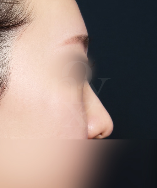 복코+매부리코 수술 전 측면