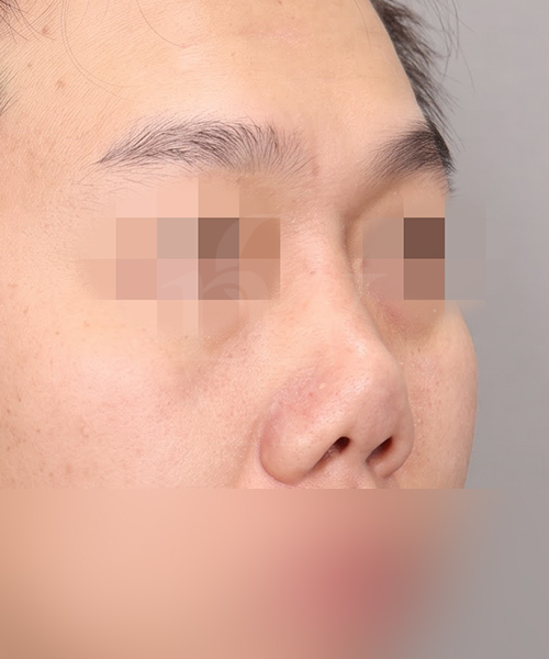 구축코 재수술 수술 전 45도