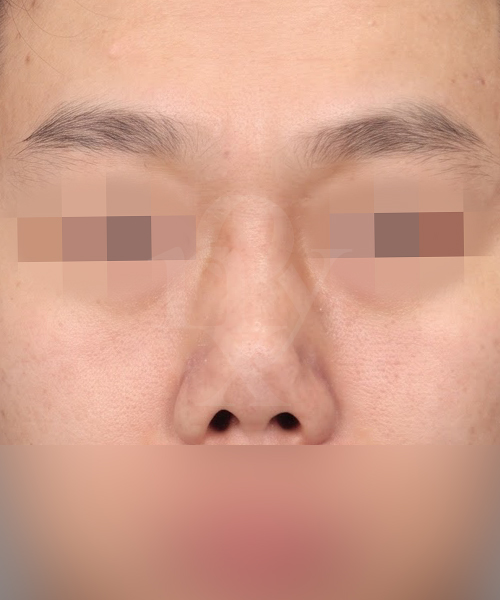 구축코 재수술 수술 전 정면