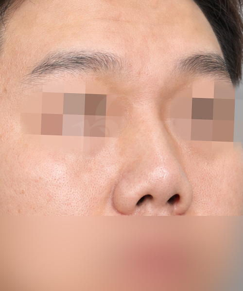 구축코 재수술 수술 한달 후 45도