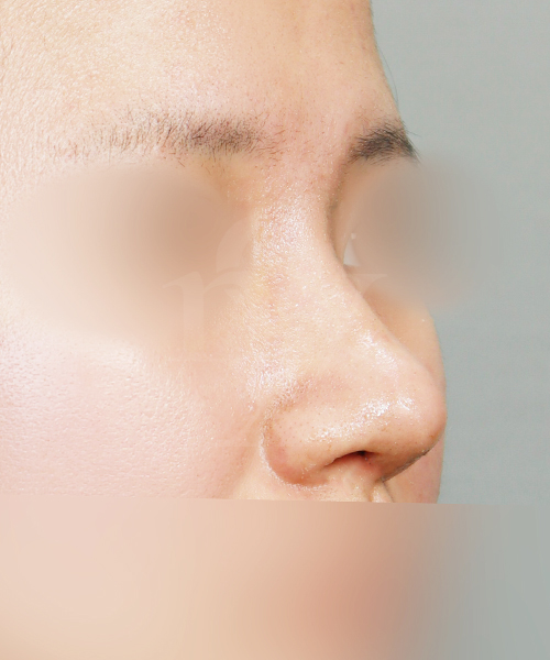 낮은코 수술 한달 후 45도