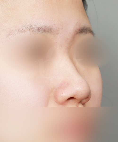 낮은코 수술 전 45도