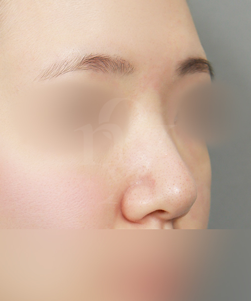 복코교정 수술 전 45도