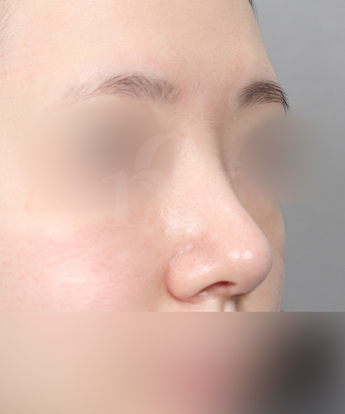 복코교정 수술 한달 후 45도