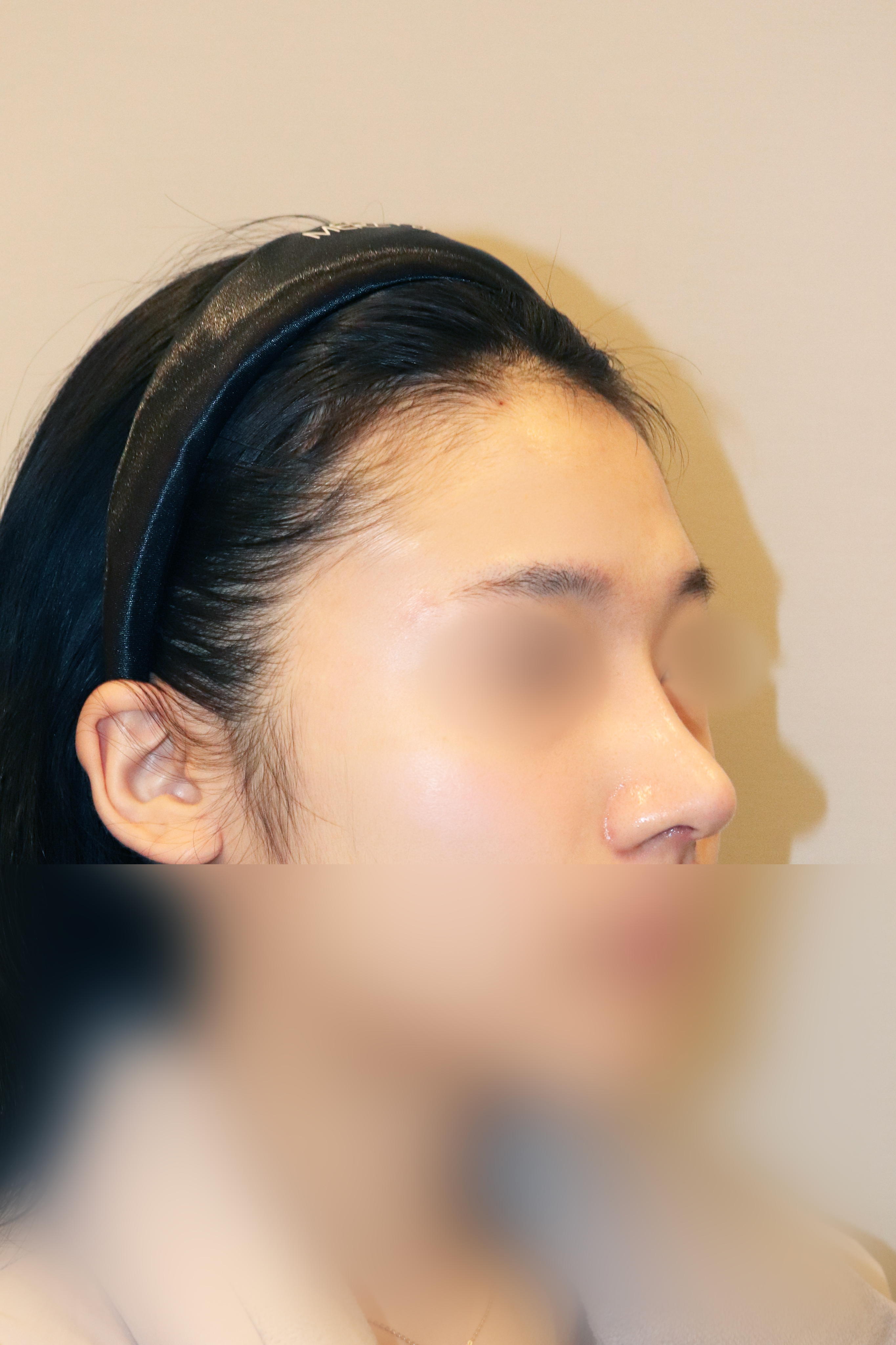 복코+낮은코교정 수술 한달 후 45도