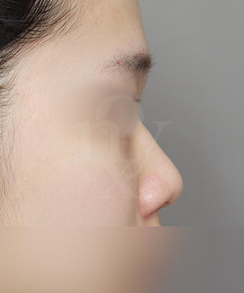 복코+낮은코교정 수술 전 측면