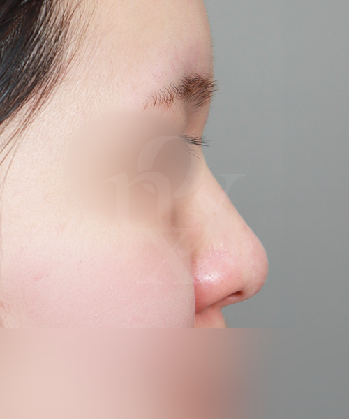 복코교정 수술 전 측면