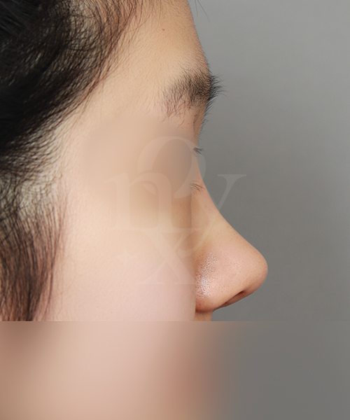 낮은코 + 복코 수술 한달 후 측면