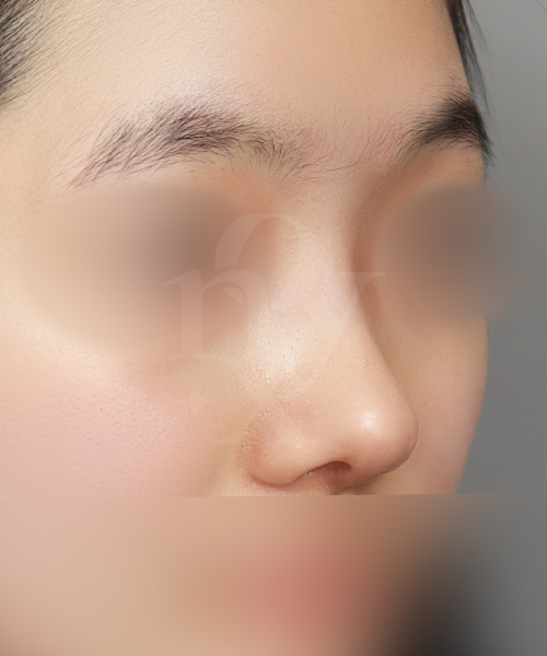 낮은코 + 복코 수술 한달 후 45도