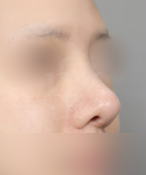 매부리코 수술 한달 후 45도