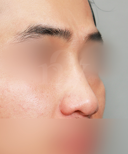 복코+낮은코교정 수술 전 45도