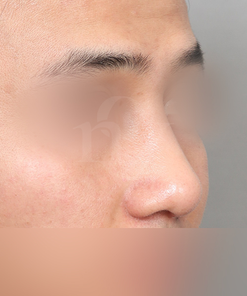 복코+낮은코교정 수술 한달 후 45도