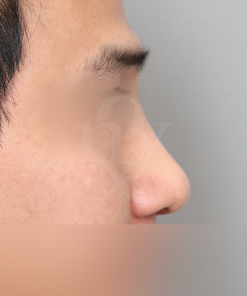 복코+낮은코교정 수술 한달 후 측면