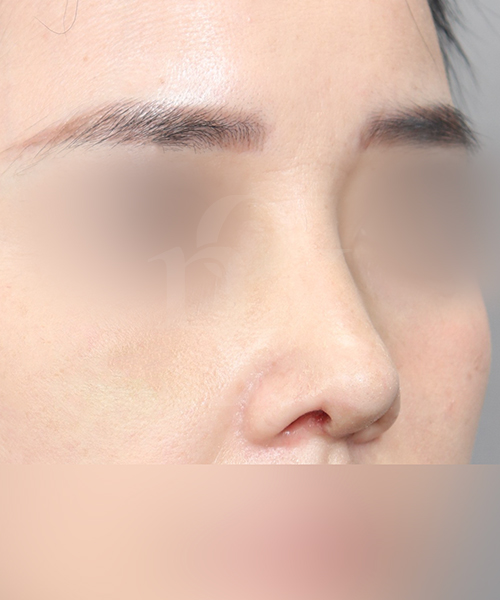 복코교정 수술 한달 후 45도