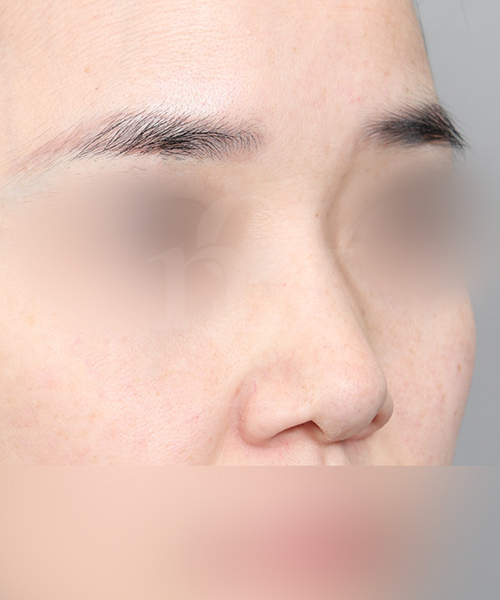 복코교정 수술 전 45도