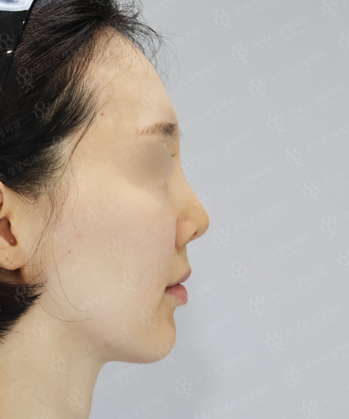 자가늑 코재수술[비주교정+비대칭교정] 수술 전 측면