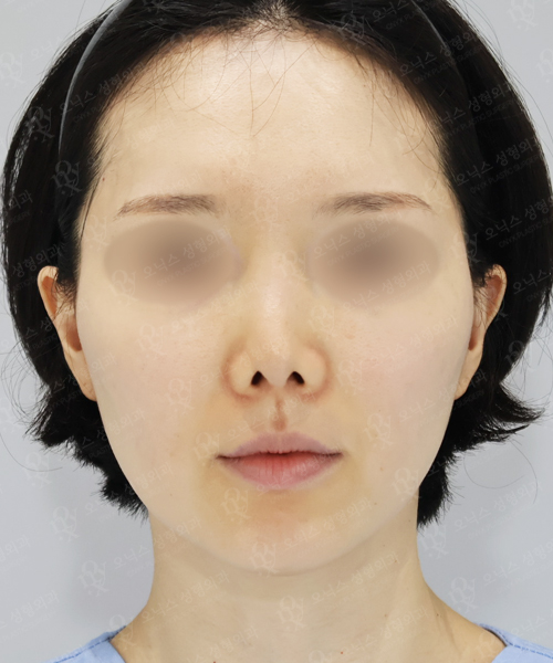 자가늑 코재수술[비주교정+비대칭교정] 수술 전 정면
