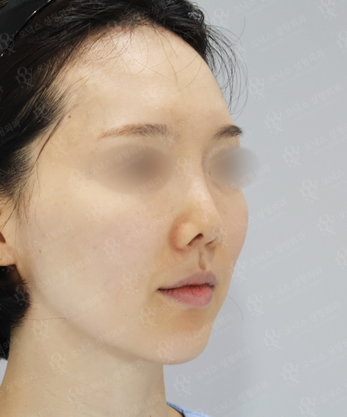 자가늑 코재수술[비주교정+비대칭교정] 수술 전 45도