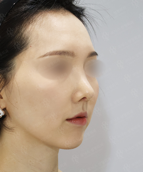 자가늑 코재수술[비주교정+비대칭교정] 수술 한달 후 45도