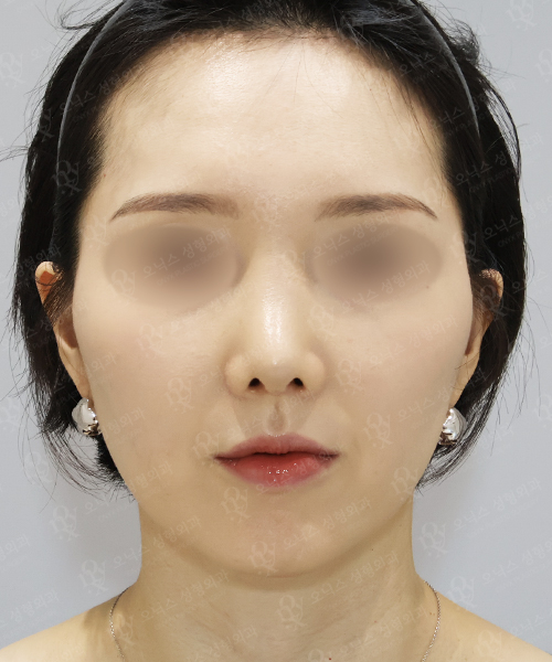 자가늑 코재수술[비주교정+비대칭교정] 수술 한달 후 정면