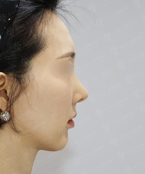 자가늑 코재수술[비주교정+비대칭교정] 수술 한달 후 측면