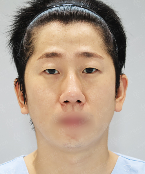 복코+매부리코+매몰 쌍꺼풀+눈매교정+뒤밑트임 수술 전 정면