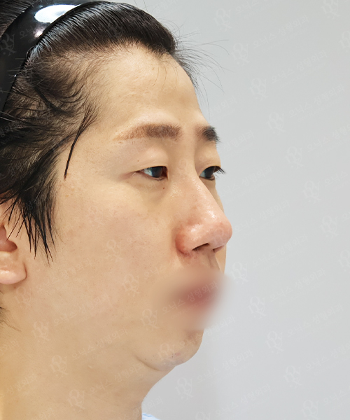 복코+매부리코+매몰 쌍꺼풀+눈매교정+뒤밑트임 수술 전 45도