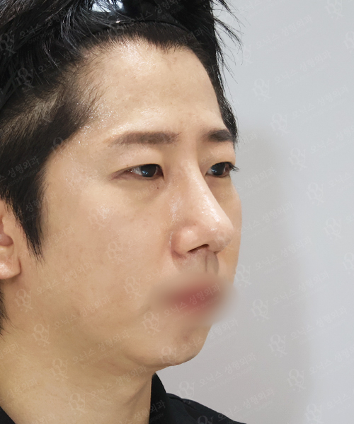 복코+매부리코+매몰 쌍꺼풀+눈매교정+뒤밑트임 수술 한달 후 45도