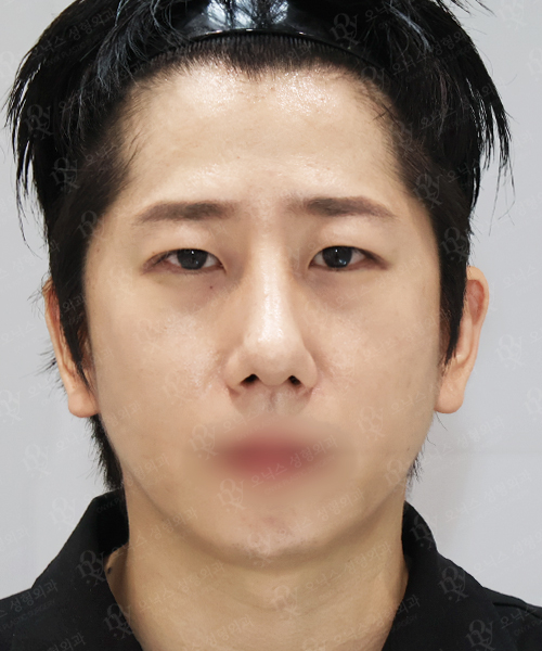 복코+매부리코+매몰 쌍꺼풀+눈매교정+뒤밑트임 수술 한달 후 정면