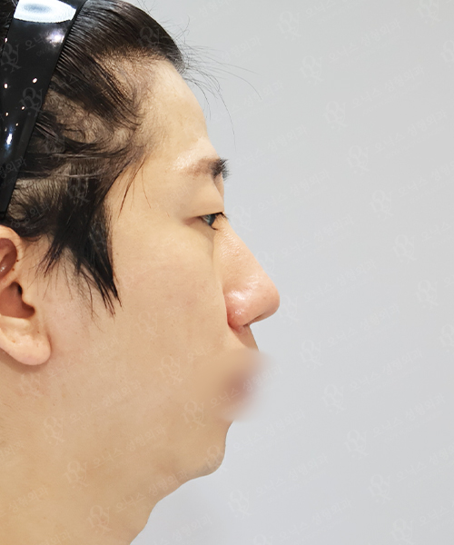 복코+매부리코+매몰 쌍꺼풀+눈매교정+뒤밑트임 수술 전 측면