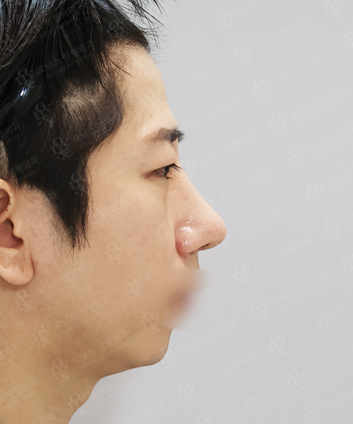 복코+매부리코+매몰 쌍꺼풀+눈매교정+뒤밑트임 수술 한달 후 측면