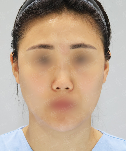 낮은코+비주교정+이마지방이식 수술 전 정면