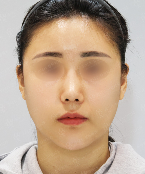 낮은코+비주교정+이마지방이식 수술 한달 후 정면