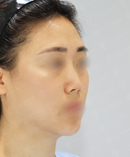 낮은코+비주교정+이마지방이식 수술 전 45도